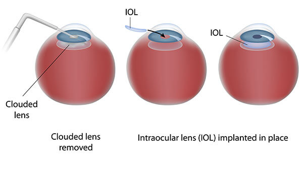 Chart Illustrating the Cataract Surgery Process