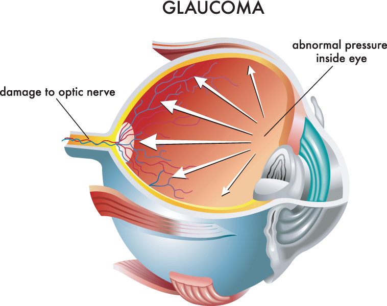 Medical illustration of the causes of glaucoma.