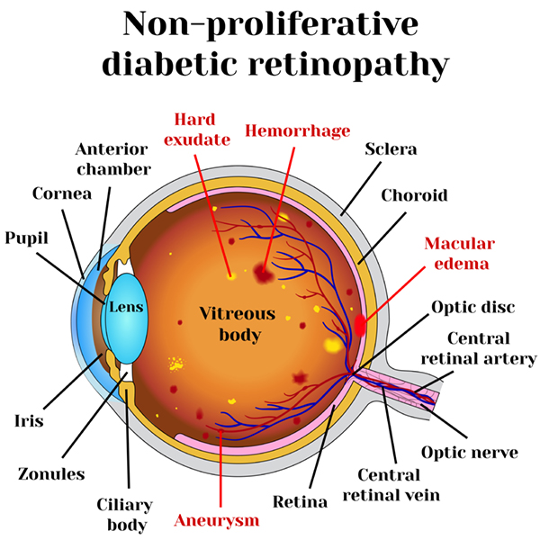Diagram explaining non-proliferative diabetic retinopathy