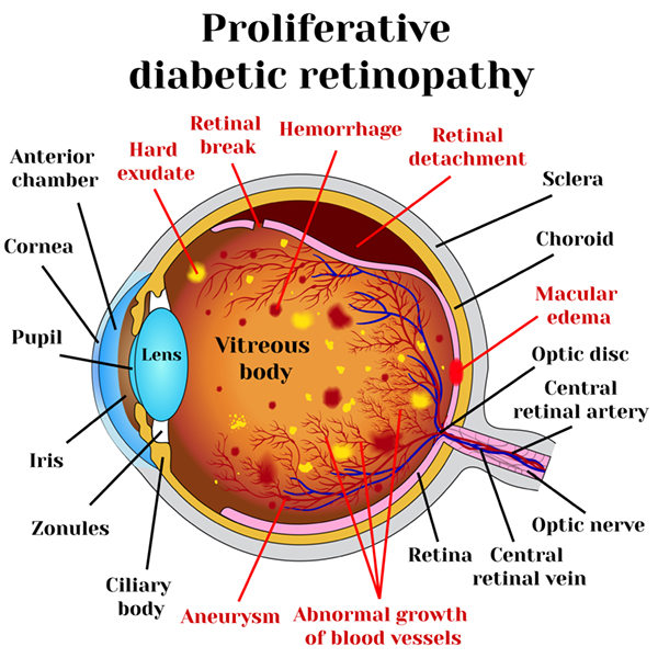 Diagram explaining proliferative diabetic retinopathy
